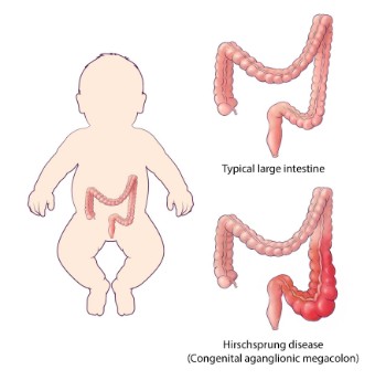 graphic of  Hirschsprung disease in the large intestines of a baby
