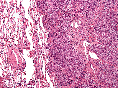 Intermediate magnification micrograph of Ewing sarcoma in lung