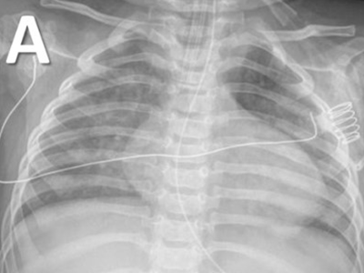x-ray of child&#039;s chest with COVID