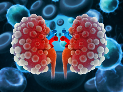 illustration of diseased kidneys