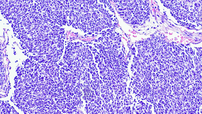 histological image of Wilms Tumor