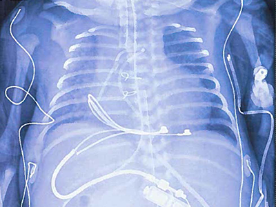 chest x-ray showing placement of tiny pacemaker