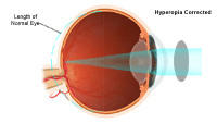 Illustration demonstrating hyperopia corrected