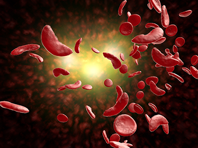 red blood cells with sickle cell anemia