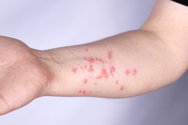 A man's forearm with a red monkeypox rash on it.