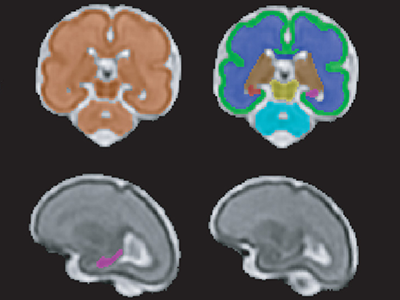 T2-Weighted Magnetic Resonance (MR) Imaging Brain Segmentation